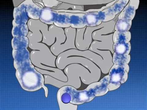 Видео о препарате Салофальк свечи (суппозитории) 250мг №30